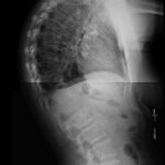 Fig 2: Picture showing patient’s kyphosis.