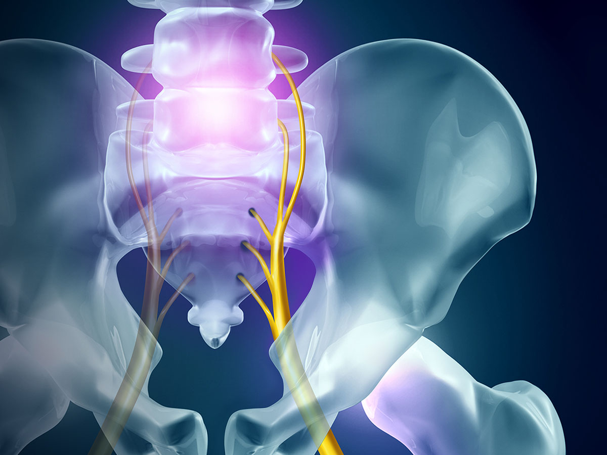 Image of a sciatic diagram