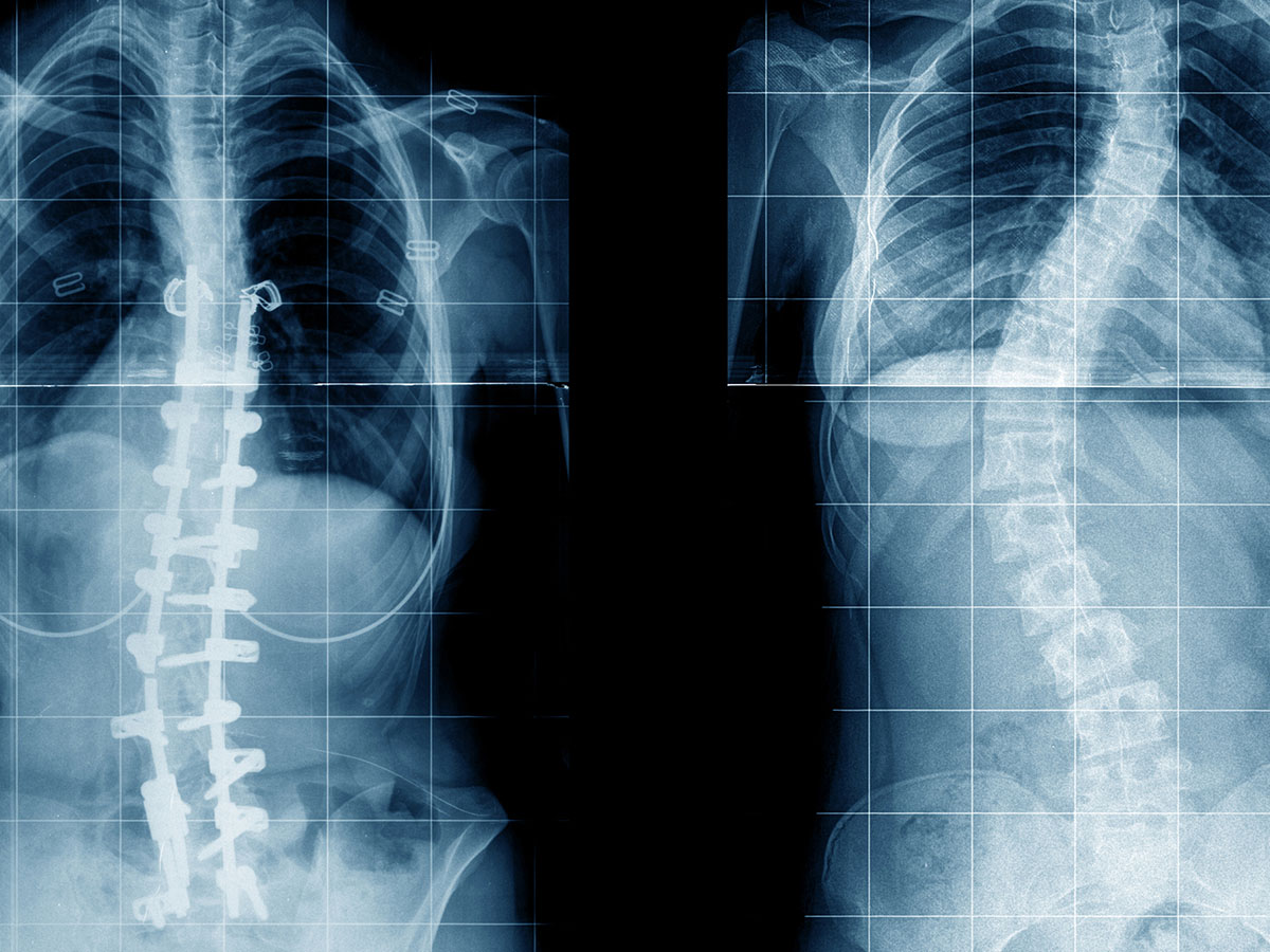Image of a scoliosis x-ray